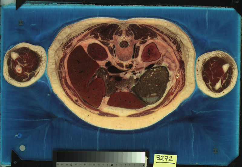 The Visible Human Project, A slice from the Visible Female. Courtesy of the US National Library of Medicine 