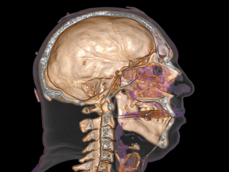 Normal head, 3D CT scan. Side view 3D model of a person’s head using X-ray computed tomography (CT) data from the Visible Human Project. Courtesy Science Photo Library/Alamy